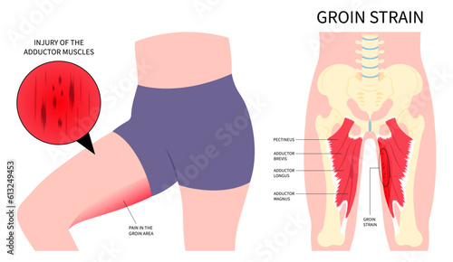 thigh pain injury Bursitis fracture in plexus flexion muscle with groin strain or hip lumbar rotation back and Obturator nerve externus lower the first aid of RICE Rest Ice stress torn photo