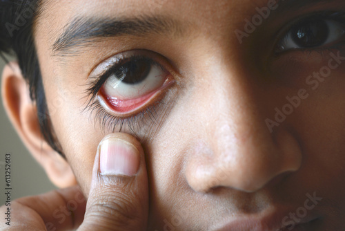 close up showing everted lower eyelid showing lower palpebral conjunctiva for looking pallor in anemia photo