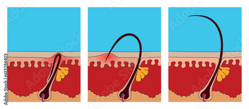 The illustration of the different stages of hairs growing - normal, ingrown and trapped under the skin. 