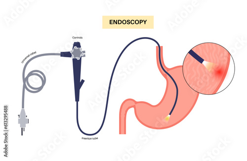Gastroscopy endoscopy procedure