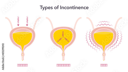 Types of Incontinence medical health vector illustration