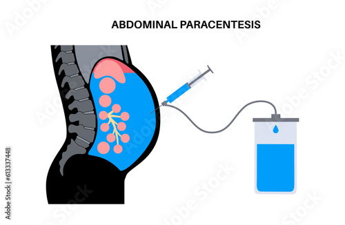 Abdominal paracentesis poster