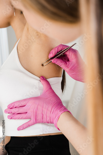 Dermatologist examines moles or birthmark of girl patient for revention of melanoma and skin cancer. Checking for benign moles. Examination of skin neoplasm and lesions of young woman.