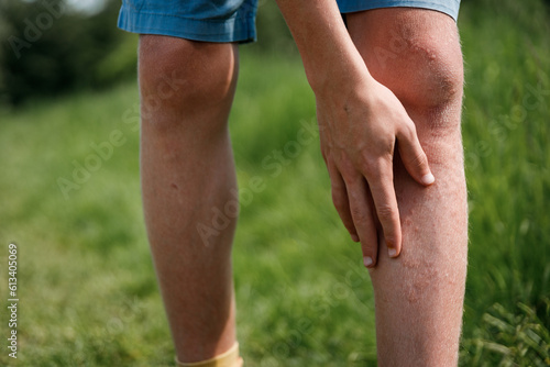 child's leg with plant irritation