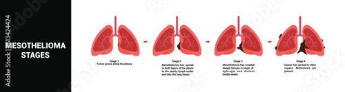 Mesothelioma cancer stages vector illustration