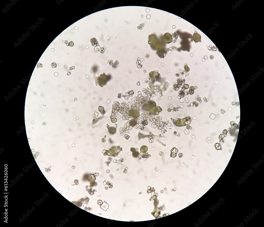 Uric acid crystal, Calcium oxalate dihydrate in urine sediment. Uric acid crystal, Calcium oxalate dihydrate in urine sediment.