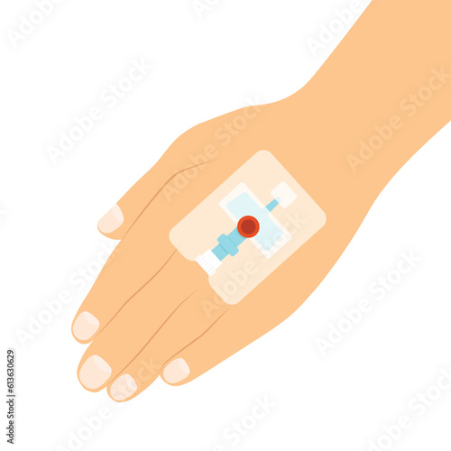 Intravenous cannula on hand- vector illustration