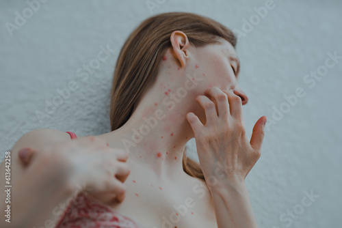 Obraz na plátně A woman with chicken pox scratches her skin