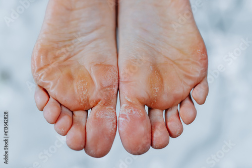 Unkempt woman feet, woman feet without pedicure photo