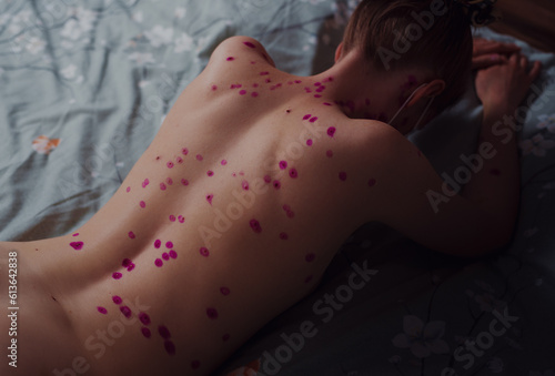 Fotografie Woman with chicken pox lying on bed