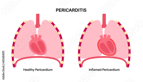 Pericarditis heart disease