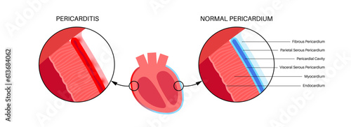 Pericarditis heart disease