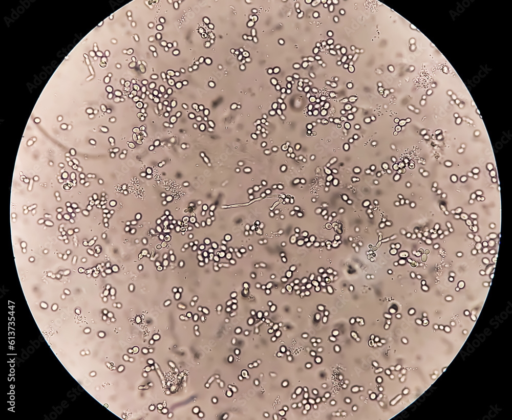 Budding yeast cells in patient urine (urinary tract infections