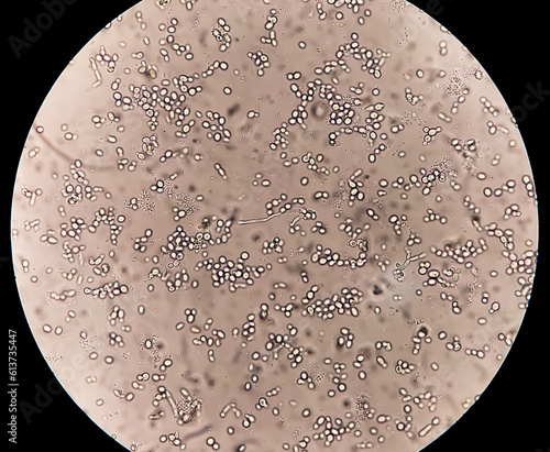 Budding yeast cells in patient urine (urinary tract infections), pyelonephritis or cystitis, analyze by microscope. photo