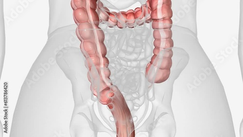 Intestinal anastomosis surgery refers to the medical procedure used to connect two ends of the gastrointestinal (GI) tract after a section of the intestines has been removed. photo