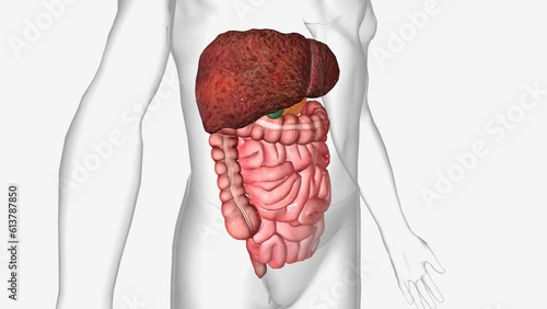 Cirrhosis is a late-stage liver disease in which healthy liver tissue is replaced with scar tissue and the liver is permanently damaged photo