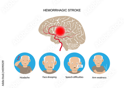 Hemorrhagic stroke and warning signs and symptoms.