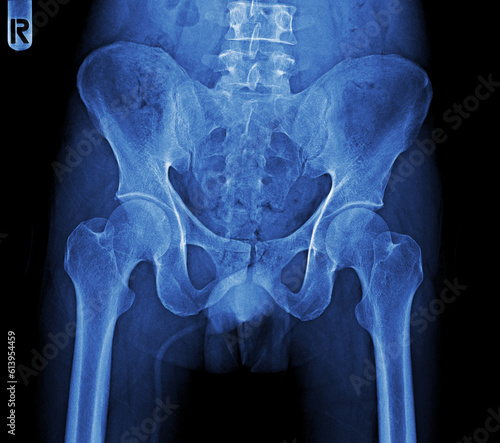 Film x-ray of human pelvis and hip joints