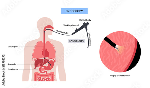 Gastroscopy endoscopy procedure