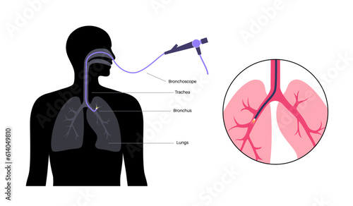 Bronchoscopy procedure concept
