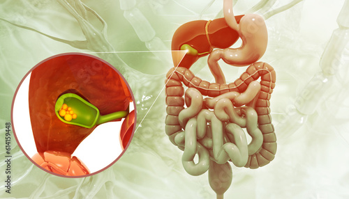 Fotografie Gallbladder cutting showing gallstones obstructing bile duct on medical background