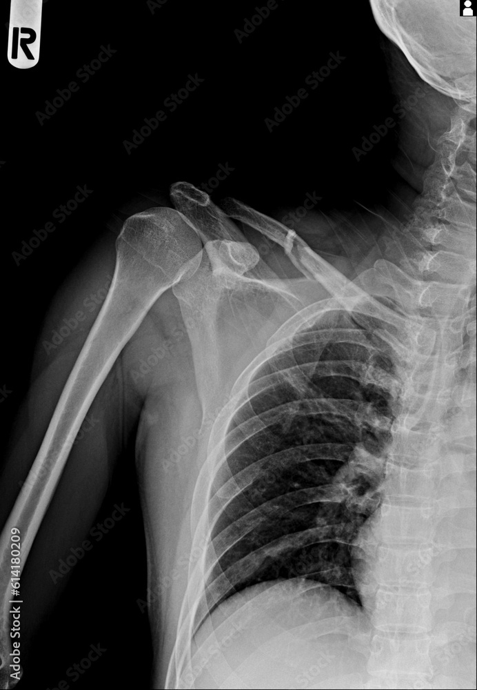 X-ray film of human shoulder show fracture X-ray film of human shoulder show fracture