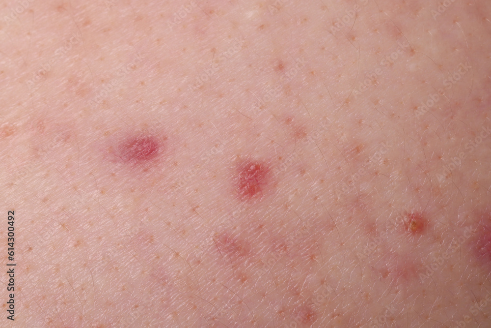 Fototapeta premium Young person with acne problem, closeup view of skin