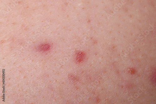 Young person with acne problem, closeup view of skin