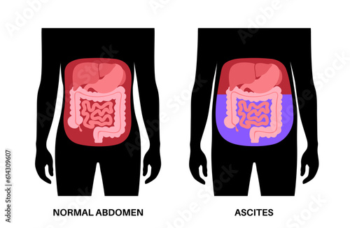Ascites disease poster