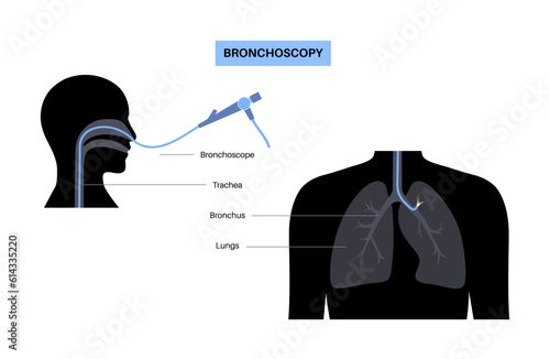 Bronchoscopy procedure concept