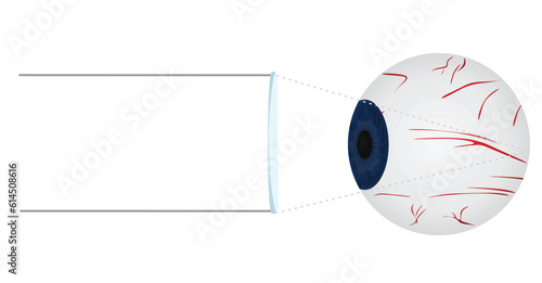 How myopia lens change eyesight. vector