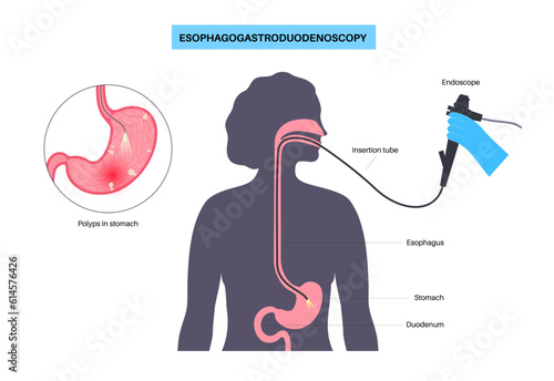 Gastroscopy endoscopy procedure
