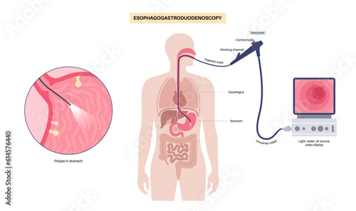 Gastroscopy endoscopy procedure