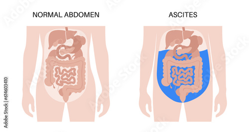 Ascites disease poster