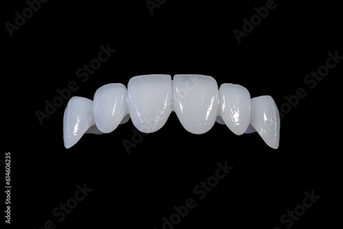 Cercon porcelain tooth bridge