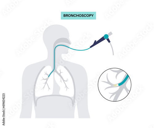 Bronchoscopy procedure concept photo