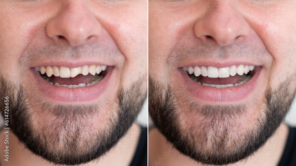 A man with a beard showing the result of his teeth treatment and whitening - before and after A man with a beard showing the result of his teeth treatment and whitening - before and after