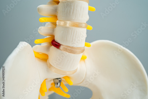 Lumbar spine displaced herniated disc fragment, spinal nerve and bone. Model for treatment medical in the orthopedic department.