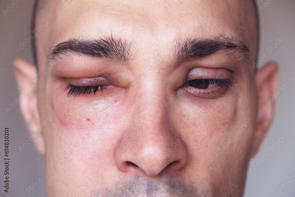 Caucasian man has angioedema around the eyes caused by allergic reaction to agents such as insect bites, foods, or medications. Swollen face, close up. Caucasian man has angioedema around the eyes caused by allergic reaction to agents such as insect bites, foods, or medications. Swollen face, close up.