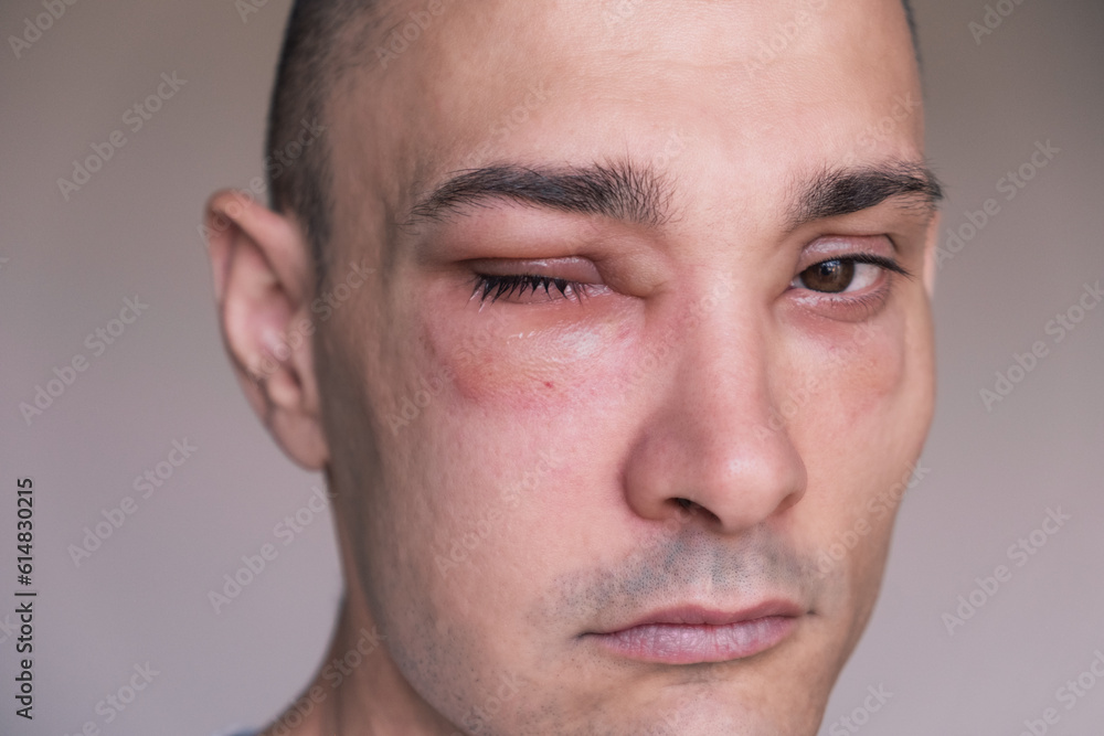 Obraz premium Caucasian man has angioedema around the eyes caused by allergic reaction to agents such as insect bites, foods, or medications. Swollen face, close up.