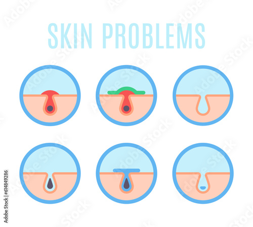 Human skin problems. Acne, black head pores and skin infections flat vector infographic illustration set