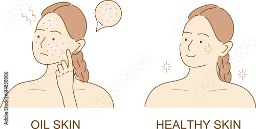 Acne skin with black dots. Face with pimples, acne. Teenager skin. The girl worries about unhealthy skin of her face. Skincare and dermatology.