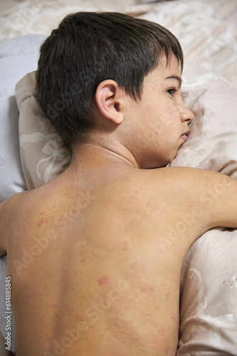Skin itching  dermatitis  food allergy on the face. A boy with red spots. The child has itching  on the face with an allergic rash.