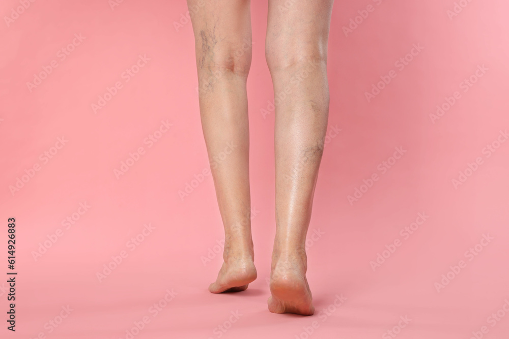 Closeup view of woman with varicose veins on pink background Closeup view of woman with varicose veins on pink background