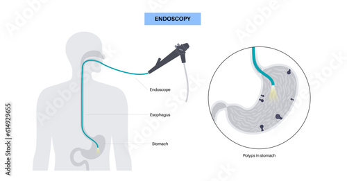 Gastroscopy endoscopy procedure