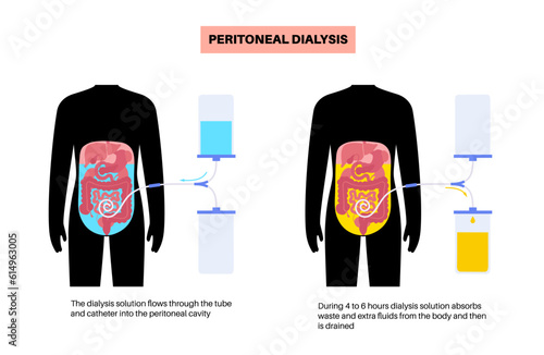 Peritoneal dialysis concept