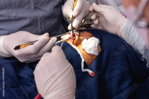 A cosmetic surgeon hold a piece of ear cartilage with tweezers to be inserted into the exposed nose columella. Tip plasty operation done simultaneously with open rhinoplasty. photo