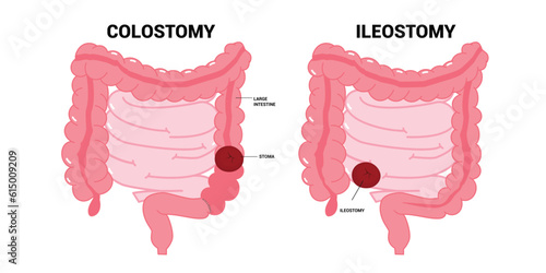 The ileum stoma abdomen Pouch for blocked poo stool system of Small Large Colon with Crohn and Hirschsprung disease inflammation Surgery hernia Cancer tract Rectal Tumor Loop invasive removal photo