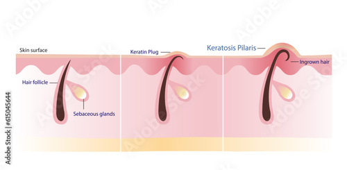The process of Keratosis Pilaris vector illustration isolated on white background. Cross section of Keratin plug, Ingrown hair, Chicken skin and Bumpy skin. Atopic Dermatitis Infographic.