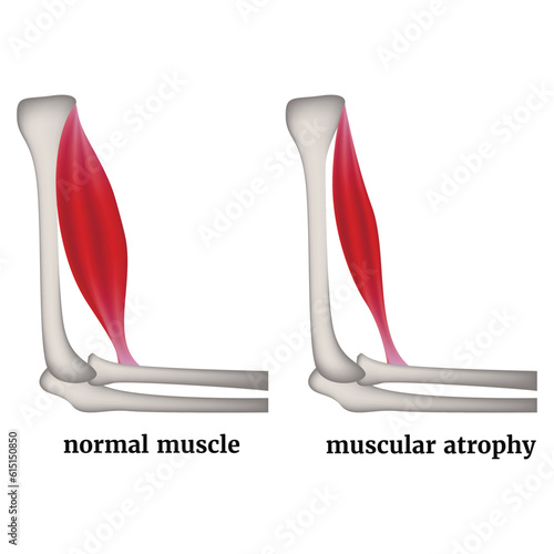 Infographic with arm muscle atrophy. Medical poster. Vector illustration photo